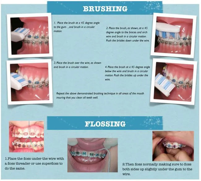 How to Take Care of Your Clear Braces Atascadero Dentist